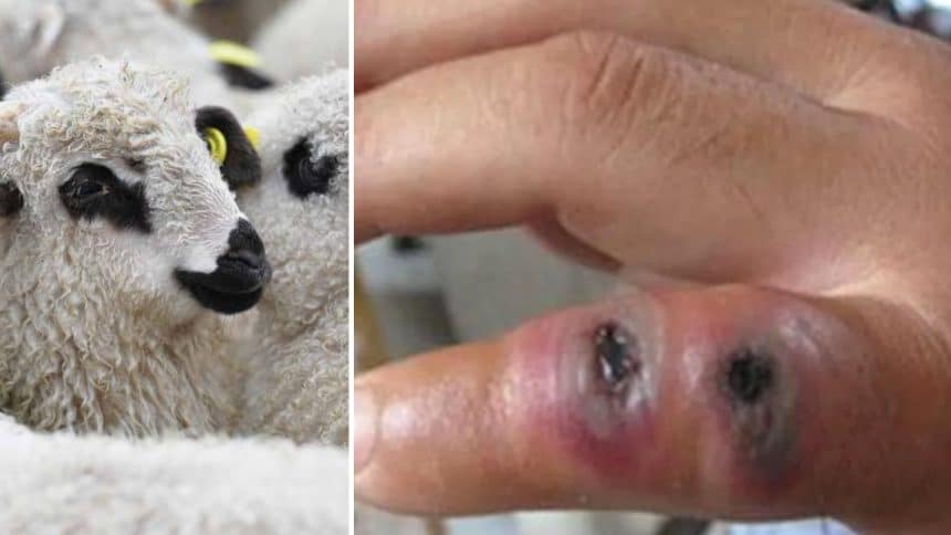 Tată și fiu diagnosticați cu antrax în România, după ce au consumat carne de oaie din gospodărie