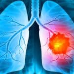 Medic pneumolog analizând o radiografie pulmonară digitală în timpul unei consultații de specialitate.