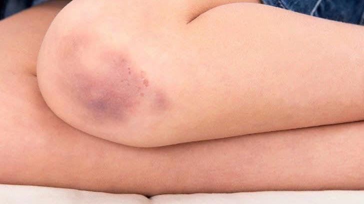 Vânătăile apărute din senin pot fi un semn al unui număr scăzut de trombocite