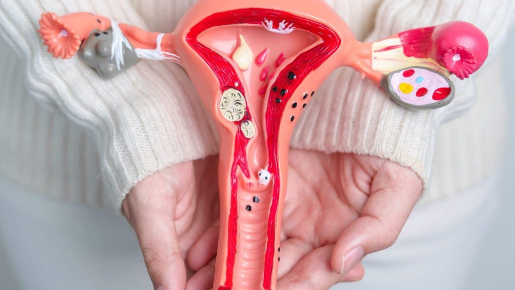 Chistul ovarian: Când devine periculos?