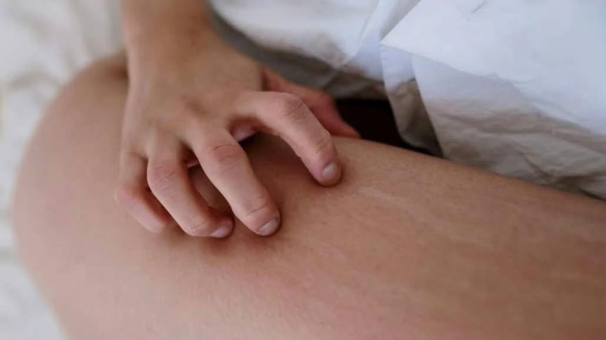 Ziua Mondială a Dermatitei Atopice: Avertismentul medicilor din Timișoara