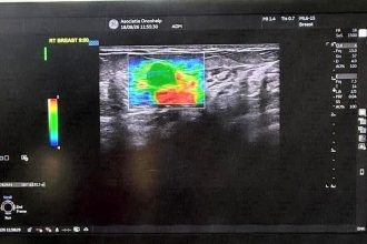 Nou ecograf la Centrul OncoHelp din Timișoara: Evaluare mai precisă a leziunilor mamare